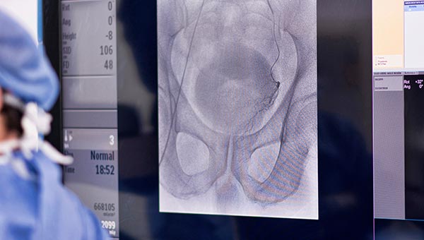 Prostate Artery Embolisation X-ray