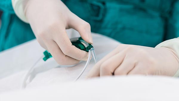 Varicocele Embolisation